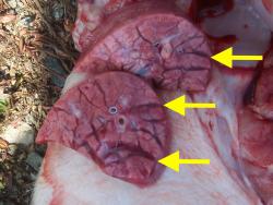 edema interlobulillar (flechas)